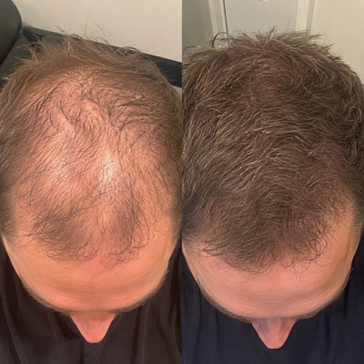 Crece Tu Cabello Naturalmente De Nuevo O Te Regresamos Tu Dinero