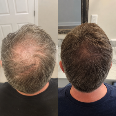 Crece Tu Cabello Naturalmente De Nuevo O Te Regresamos Tu Dinero
