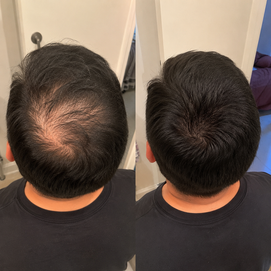 Crece Tu Cabello Naturalmente De Nuevo O Te Regresamos Tu Dinero
